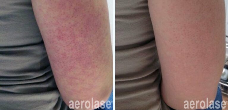 Keratosis Pilaris