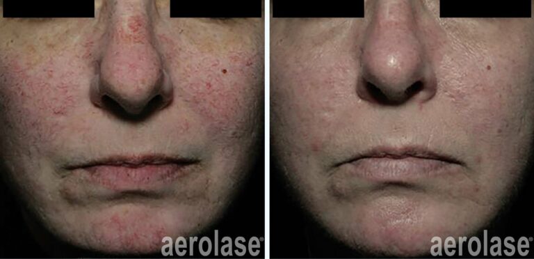 Rosacea and Redness