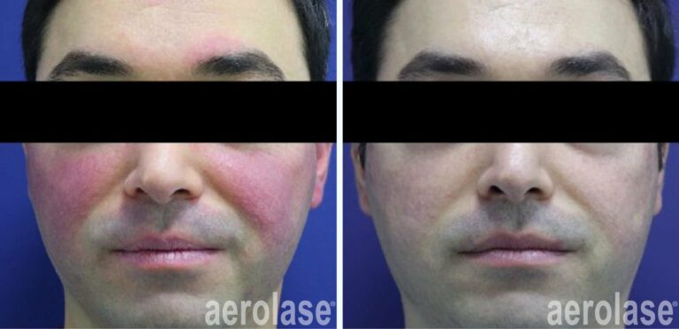 Rosacea