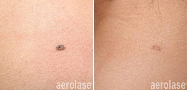 Skin Tags