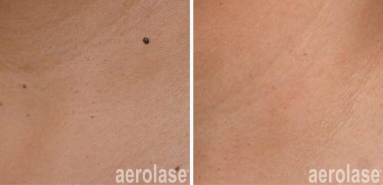Skin Tags